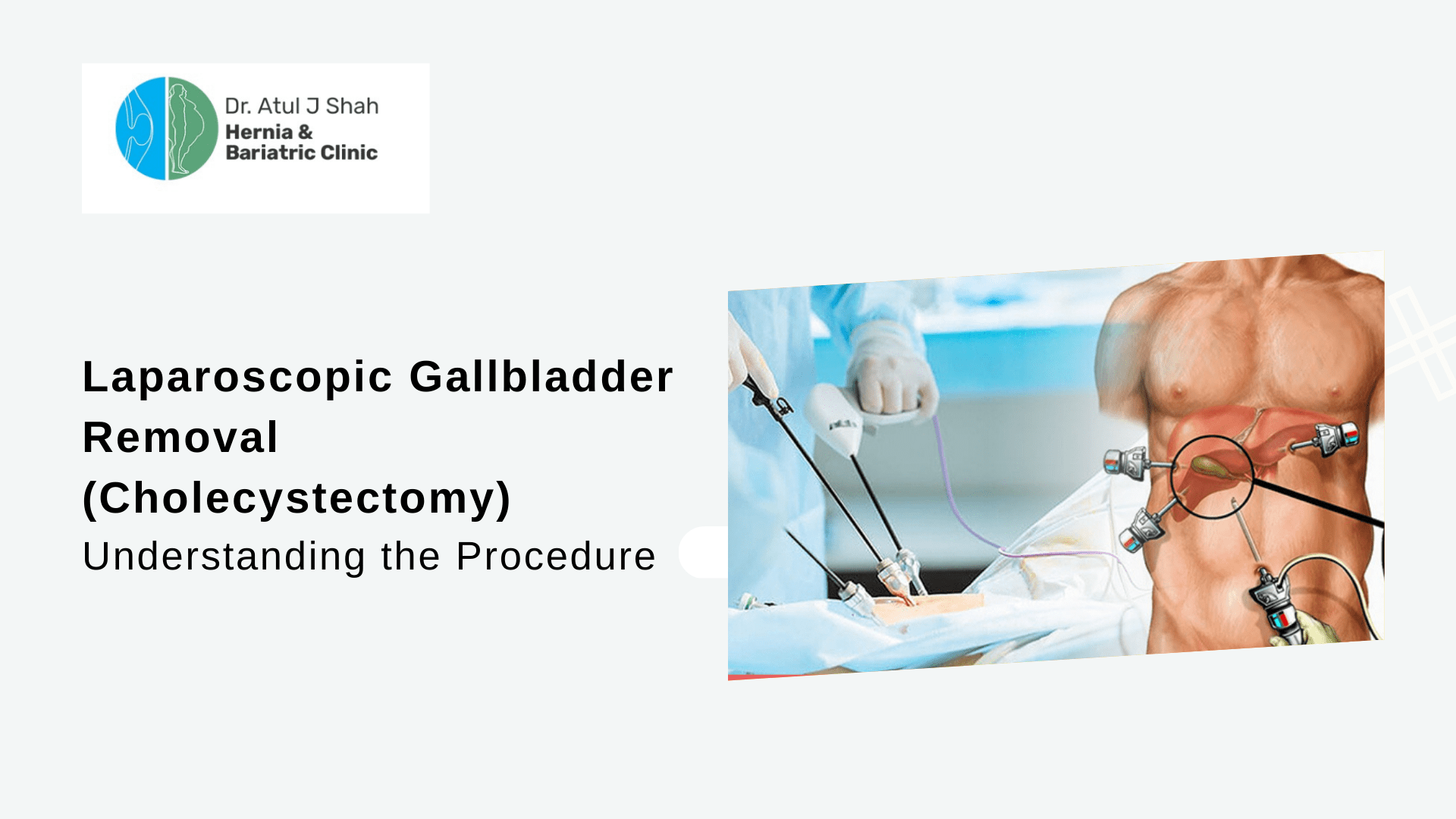 Laparoscopic Gallbladder Removal (Cholecystectomy): Understanding the Procedure