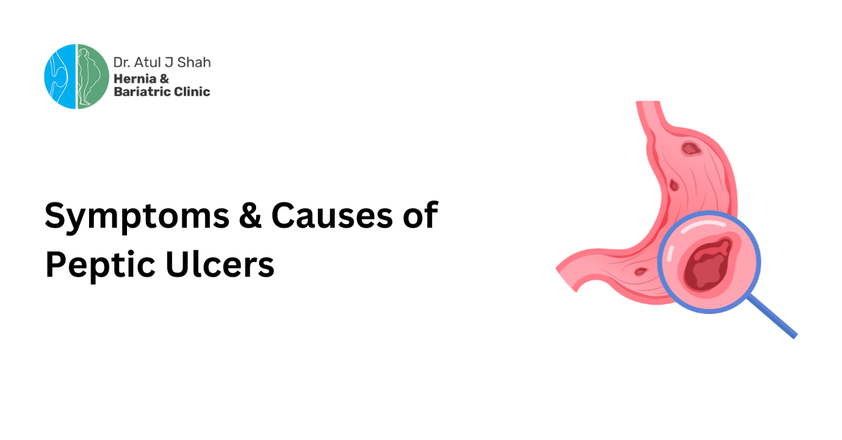 Symptoms & Causes of Peptic Ulcers