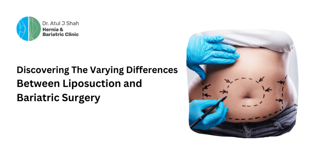 Discovering The Varying Differences Between Liposuction and Bariatric Surgery