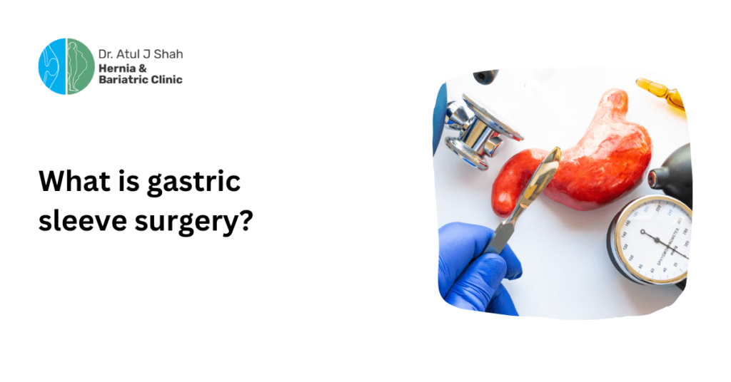What is gastric sleeve surgery?