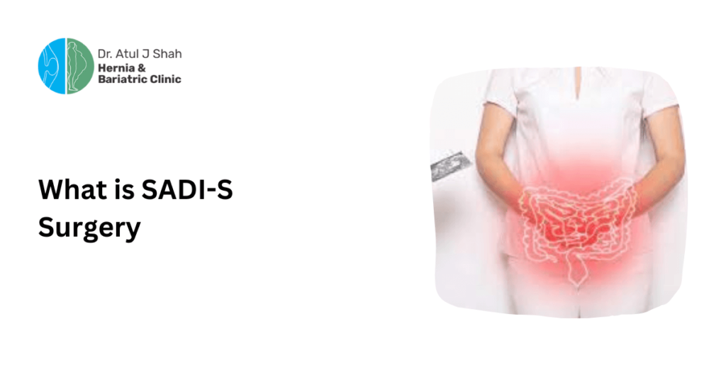 What is SADI-S Surgery