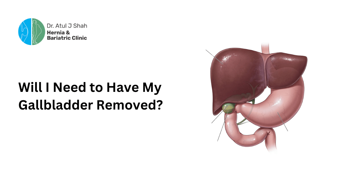 Will I Need to Have My Gallbladder Removed?