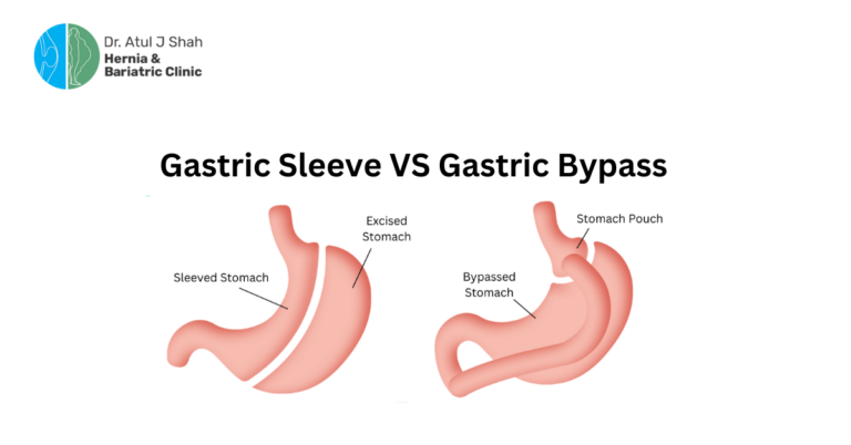Gastric Bypass vs Gastric Sleeve