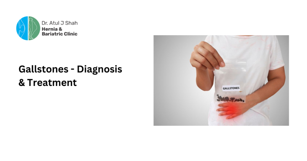 Gallstones - Diagnosis & Treatment